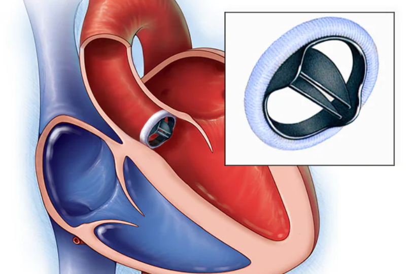 Cardiac Valve Surgery