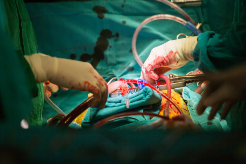 Coronary Artery Bypass Grafting
