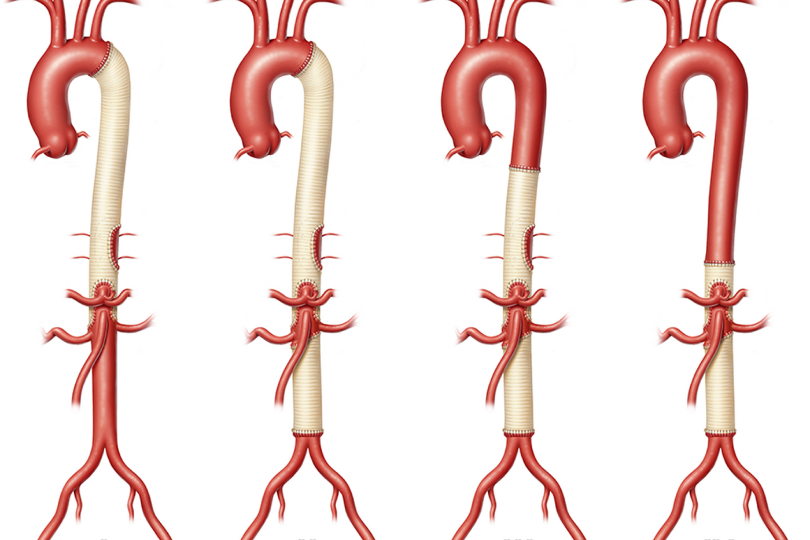 Thoracoabdominal Aortic Aneurysm Surgery