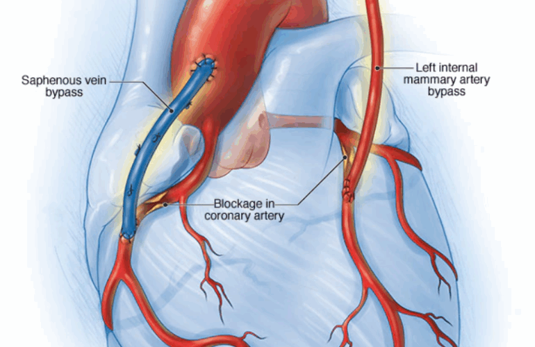Cardiac Bypass Surgery