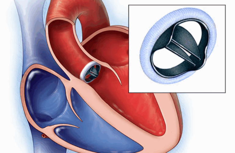 Cardiac Valve Surgery