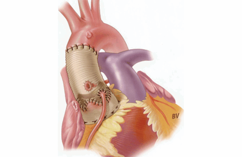 Aortic Root Replacement