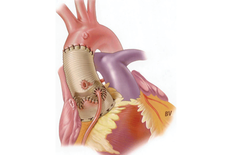 Aortic Root Replacement