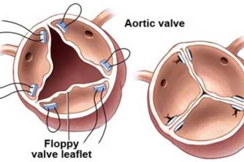 Aortic Valve Repair