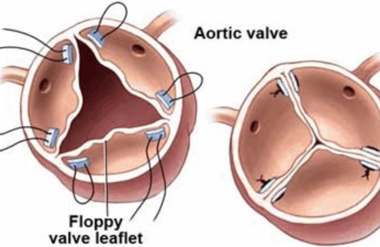 Aortic Valve Repair