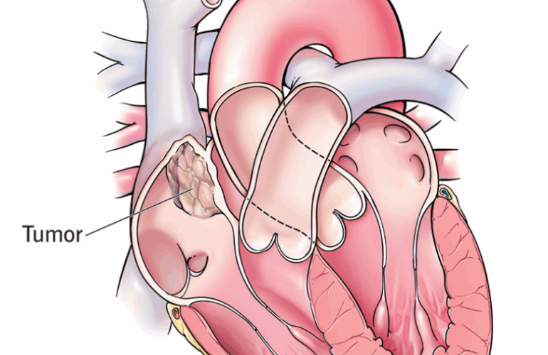 Cardiac Tumor
