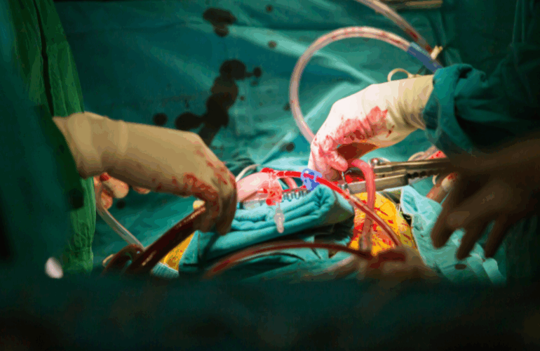Coronary Artery Bypass Grafting