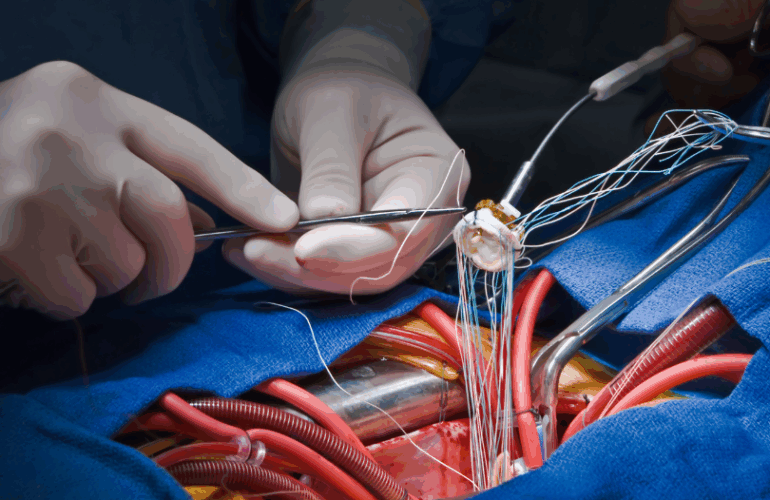 Heart Valve Replacement