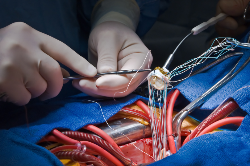 Heart Valve Replacement