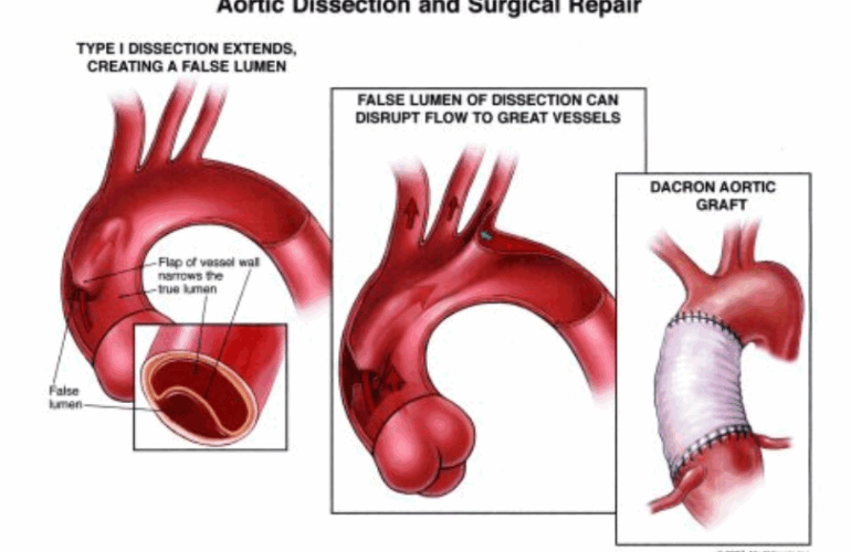 Surgical Repair and Aortic Dissection