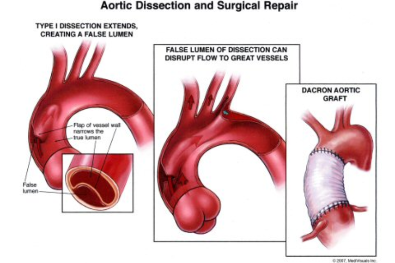 Surgical Repair and Aortic Dissection